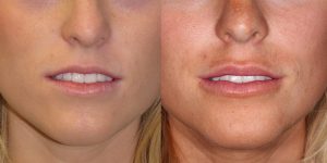 Before-And-After-Lip-Enhancement-Lip-Filler-Cosmetic-Surgery-Newport-Beach-1