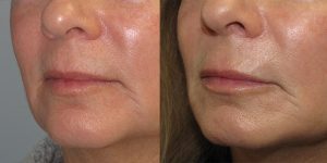 Before-And-After-Lip-Enhancement-Lip-Filler-Cosmetic-Surgery-Newport-Beach-1