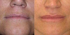 Before-And-After-Lip-Enhancement-Lip-Filler-Cosmetic-Surgery-Newport-Beach-1