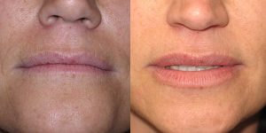 Before-And-After-Lip-Enhancement-Lip-Filler-Cosmetic-Surgery-Newport-Beach-1