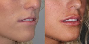 Before-And-After-Lip-Enhancement-Lip-Filler-Cosmetic-Surgery-Newport-Beach-1