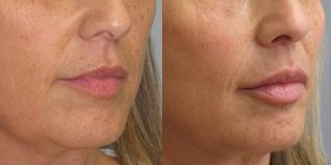 Before-And-After-Lip-Enhancement-Lip-Filler-Cosmetic-Surgery-Newport-Beach-1