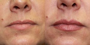 Before-And-After-Lip-Enhancement-Lip-Filler-Cosmetic-Surgery-Newport-Beach-1