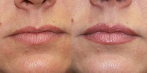 Before-And-After-Lip-Enhancement-Lip-Filler-Cosmetic-Surgery-Newport-Beach-1