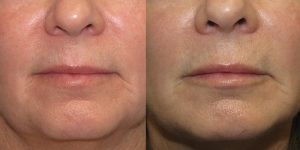 Before-And-After-Lip-Enhancement-Lip-Filler-Cosmetic-Surgery-Newport-Beach-1