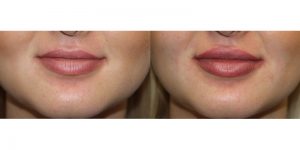 Injectable-Treatment-Steven-Daines-MD-Appearance-Center-Newport-Beach-Orange-County-Plastic-Surgery.14.1