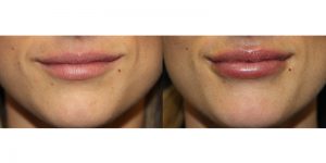 Injectable-Treatment-Steven-Daines-MD-Appearance-Center-Newport-Beach-Orange-County-Plastic-Surgery.14.1