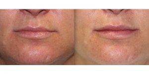 Injectable-Treatment-Steven-Daines-MD-Appearance-Center-Newport-Beach-Orange-County-Plastic-Surgery.2.1