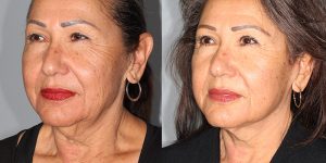 Neck-lift-Appearance-Center-Newport-Beach-Cosmetic-Surgery-Orange-County6.1